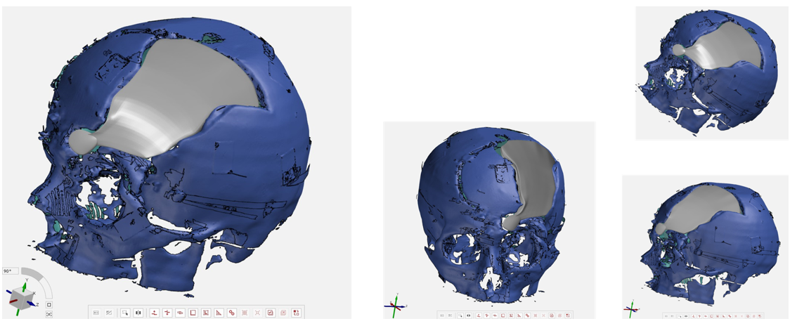 Cranial bone repair